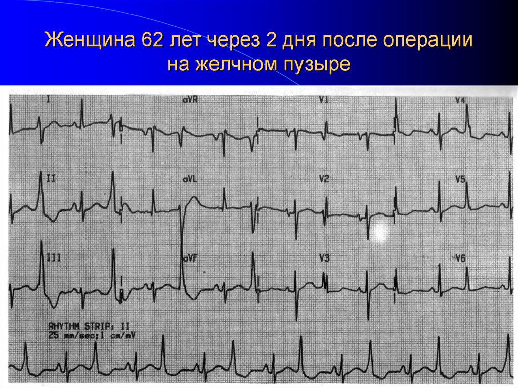 Женщина 62 лет через 2 дня после операции на желчном пузыре