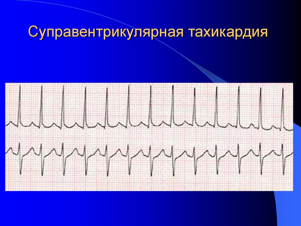 Суправентрикулярная тахикардия