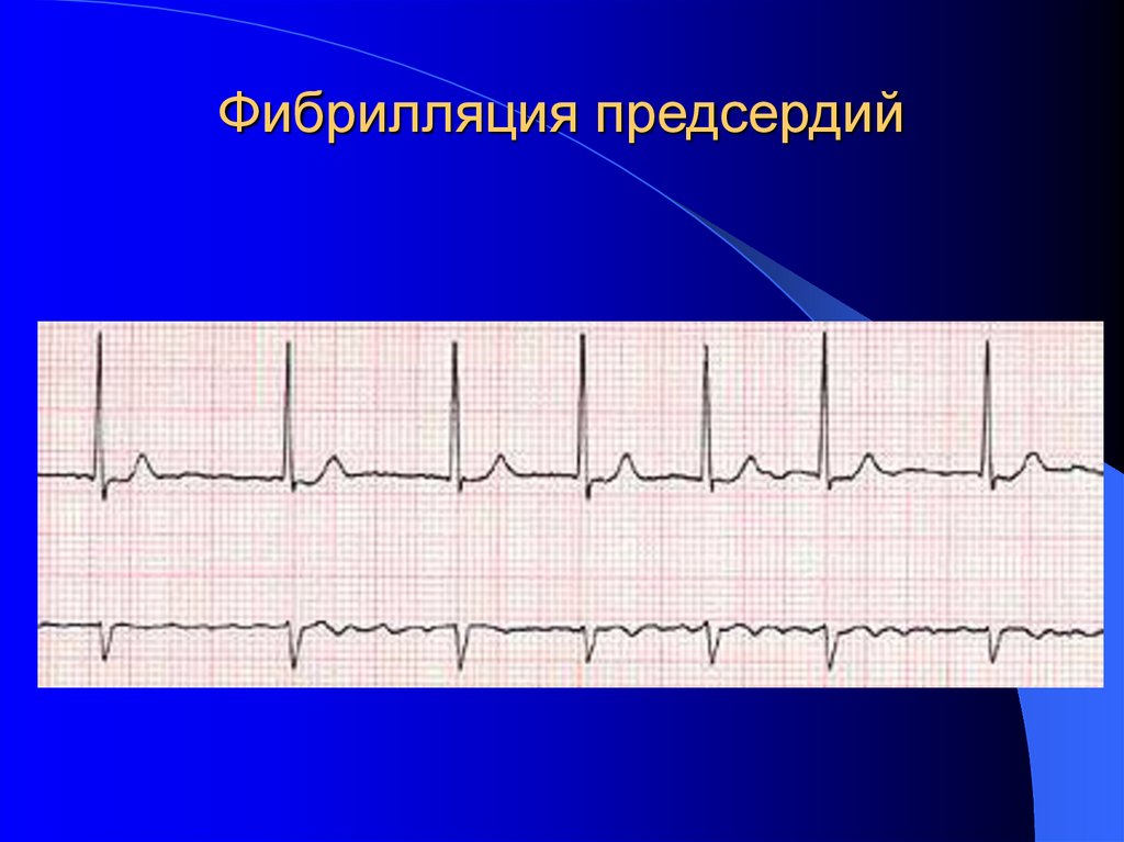 Фибрилляция предсердий