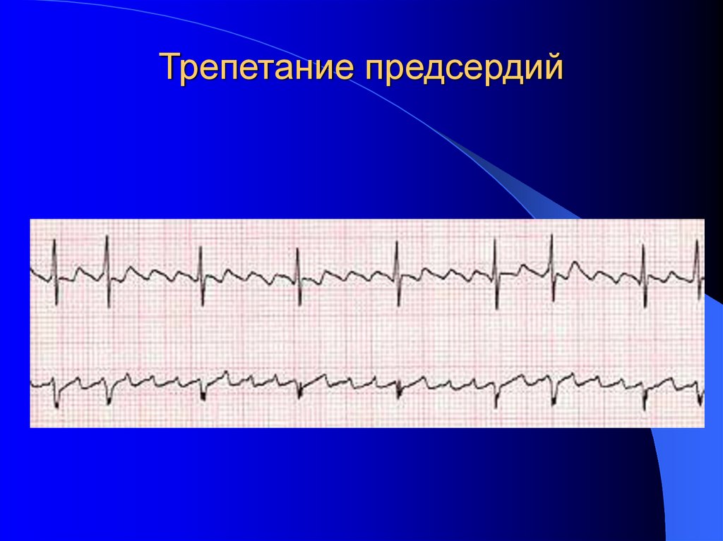 Трепетание предсердий