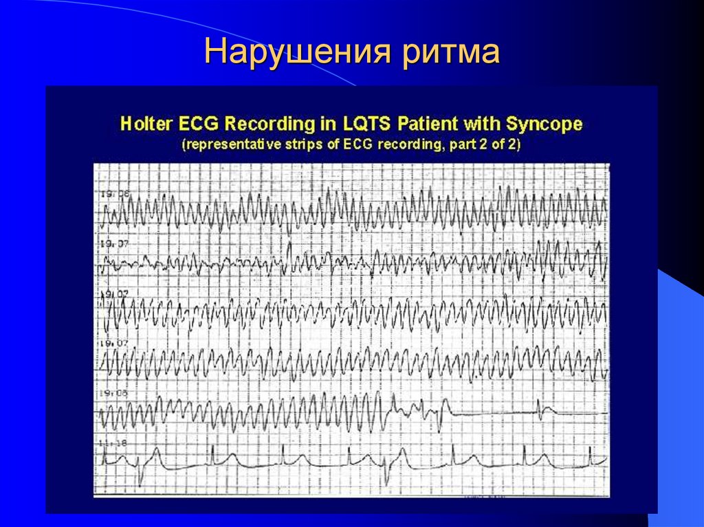 Нарушения ритма