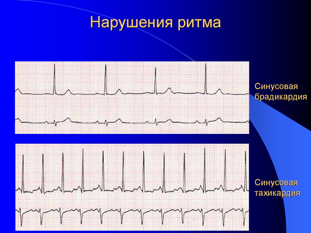 Нарушения ритма
