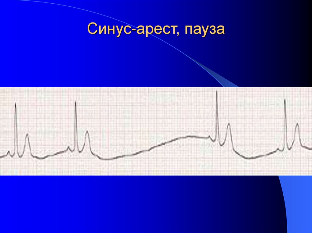 Синус-арест, пауза