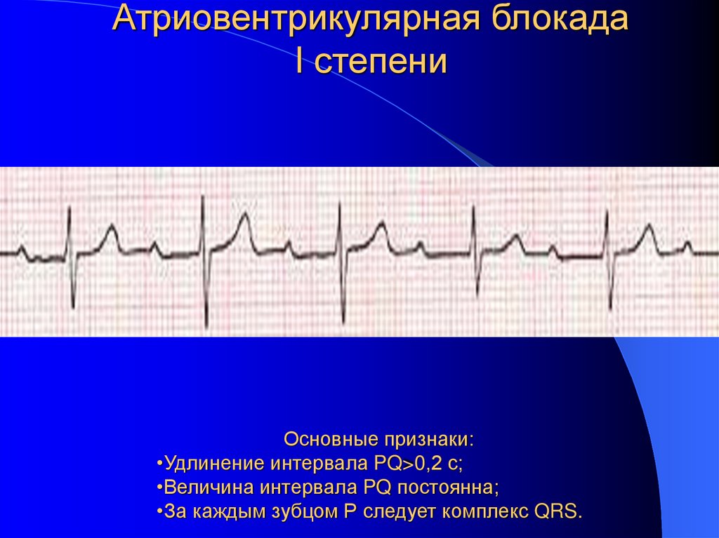 Атриовентрикулярная блокада I степени