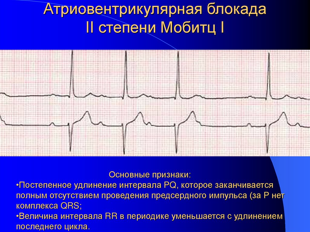 Атриовентрикулярная блокада II степени Мобитц I