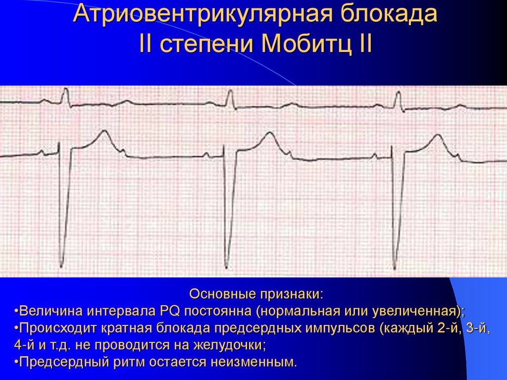 Атриовентрикулярная блокада II степени Мобитц II