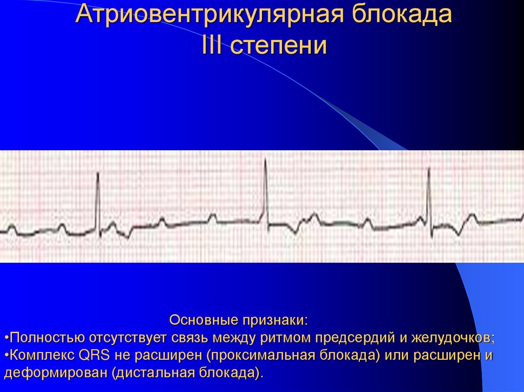 Атриовентрикулярная блокада III степени