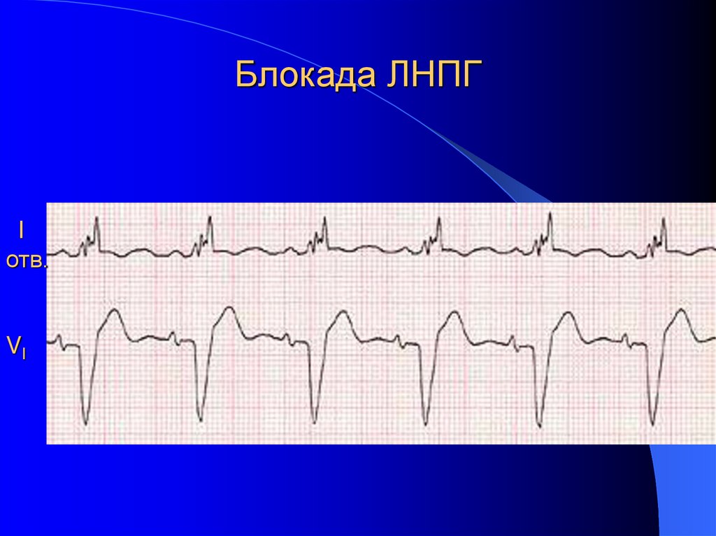Блокада ЛНПГ