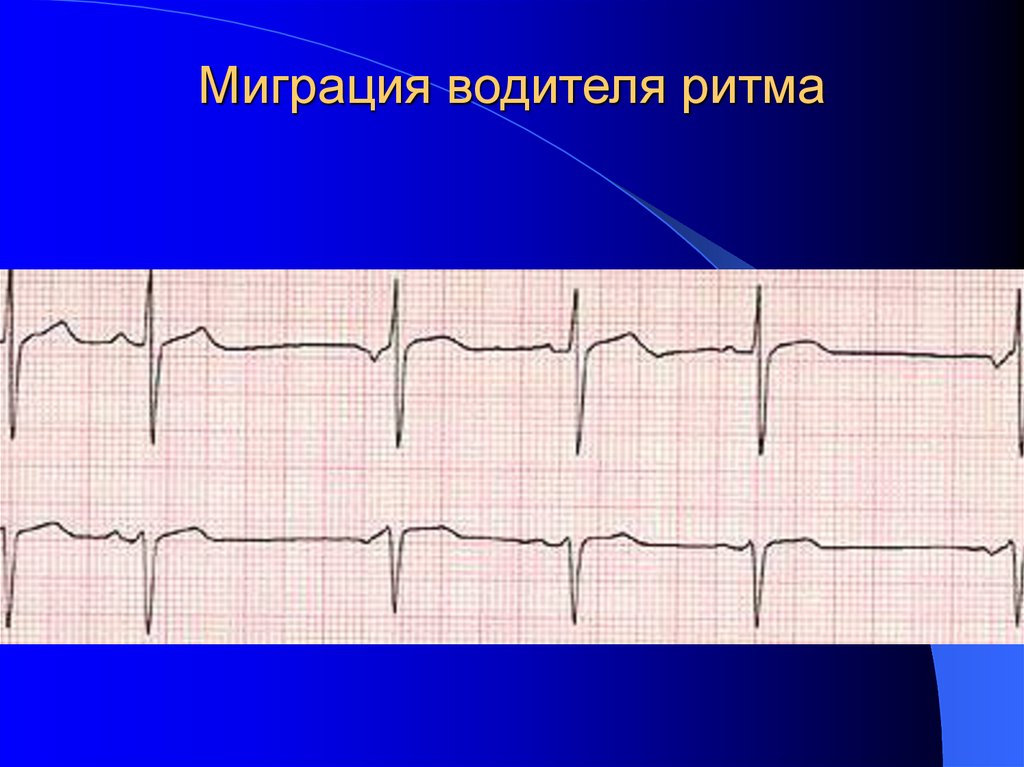 Миграция водителя ритма