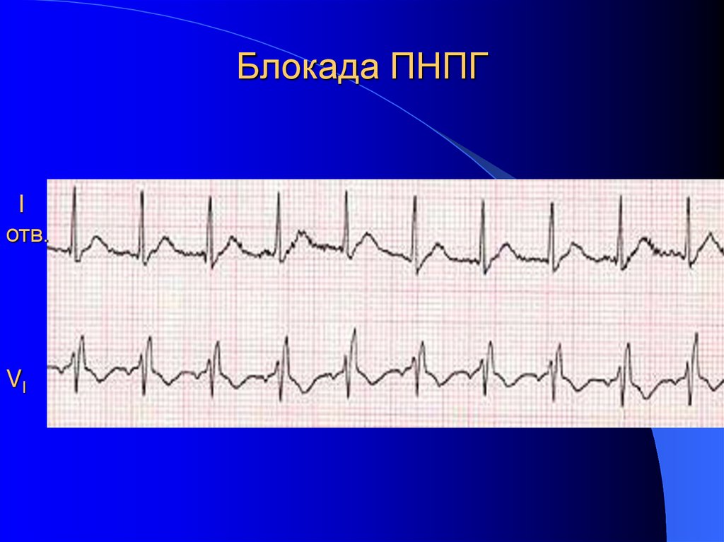 Блокада ПНПГ