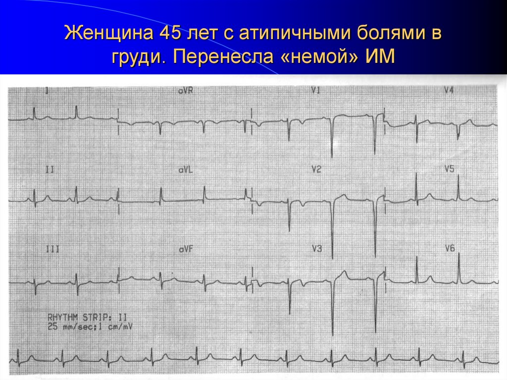Женщина 45 лет с атипичными болями в груди. Перенесла «немой» ИМ