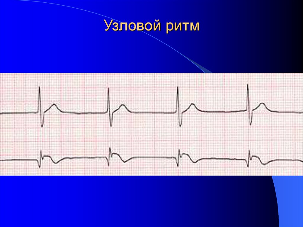 Узловой ритм