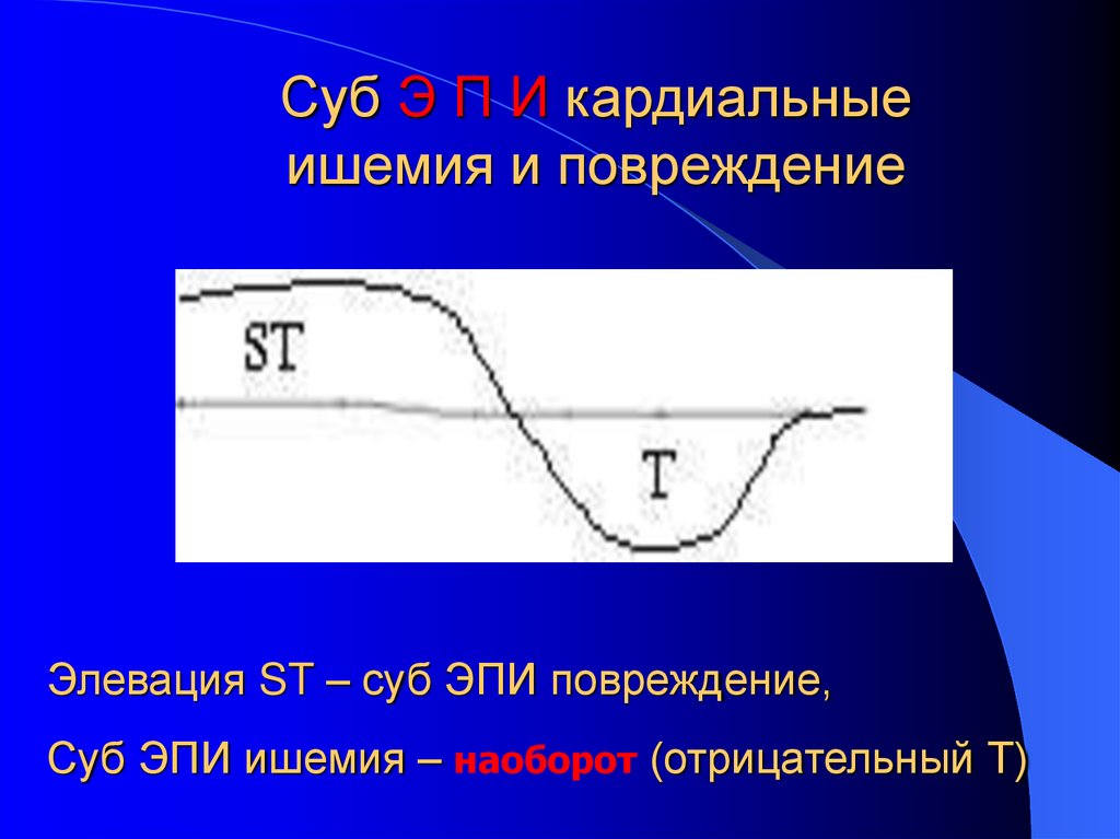 Суб Э П И кардиальные ишемия и повреждение