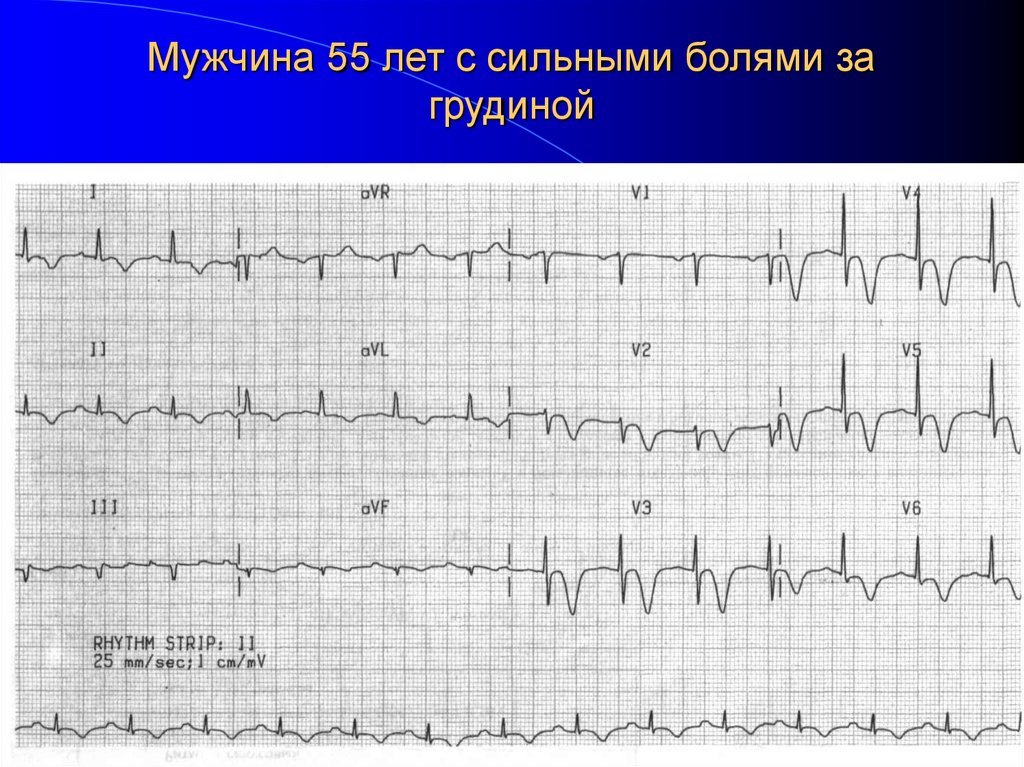 Мужчина 55 лет с сильными болями за грудиной