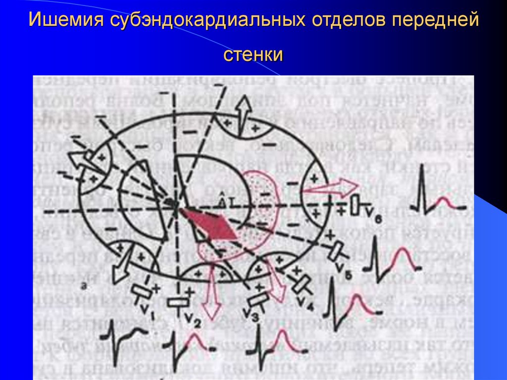 Ишемия субэндокардиальных отделов передней стенки
