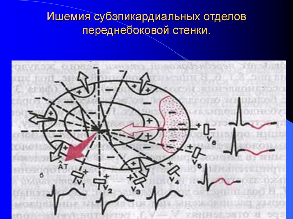 Ишемия субэпикардиальных отделов переднебоковой стенки.