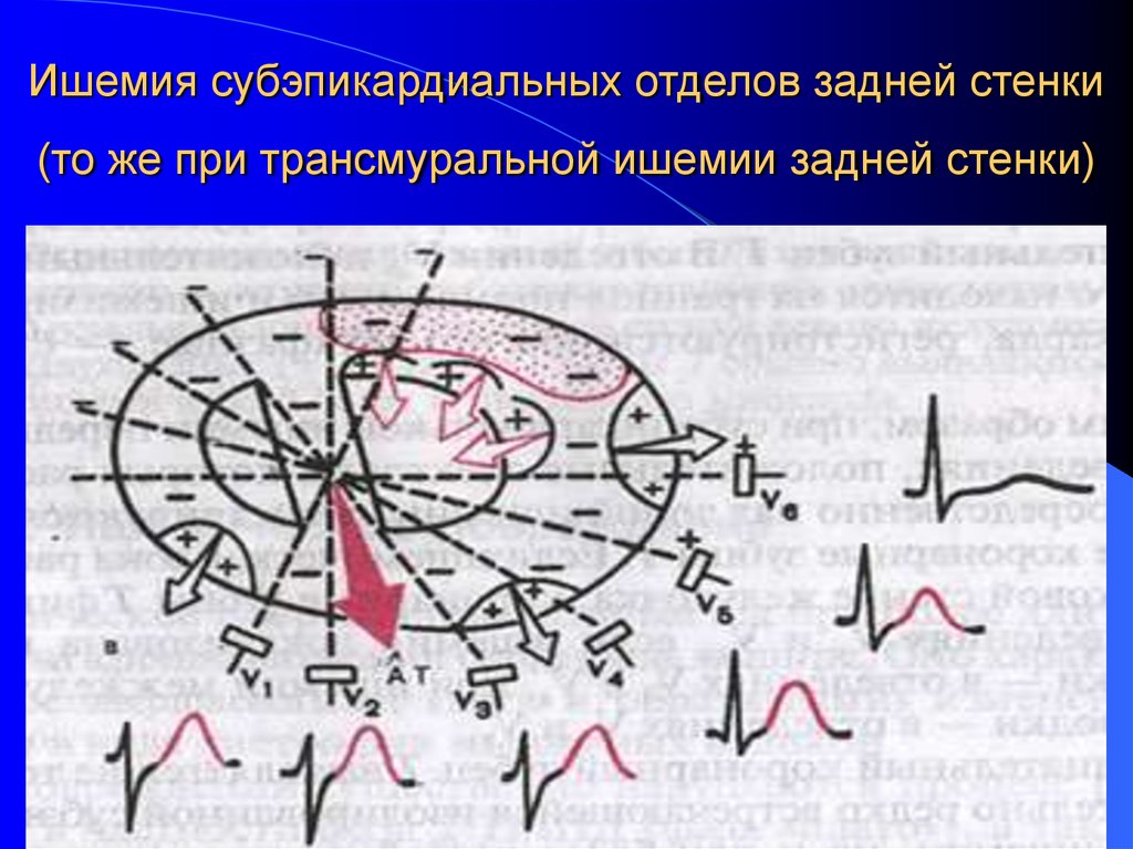 Ишемия субэпикардиальных отделов задней стенки (то же при трансмуральной ишемии задней стенки)