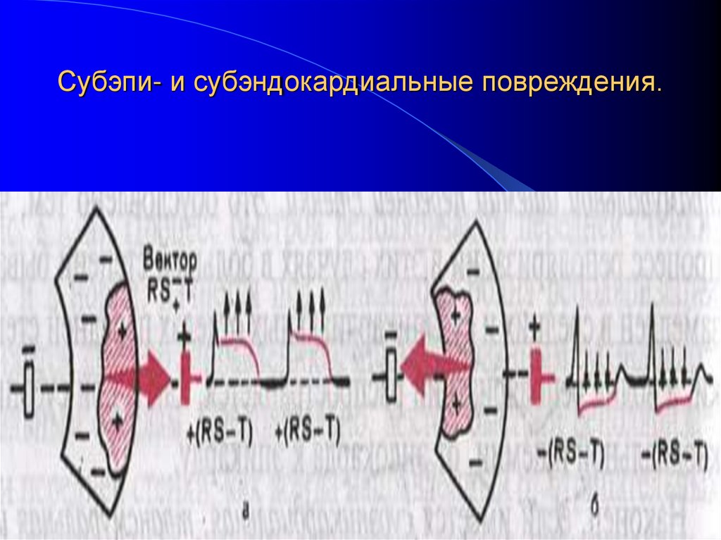 Субэпи- и субэндокардиальные повреждения.
