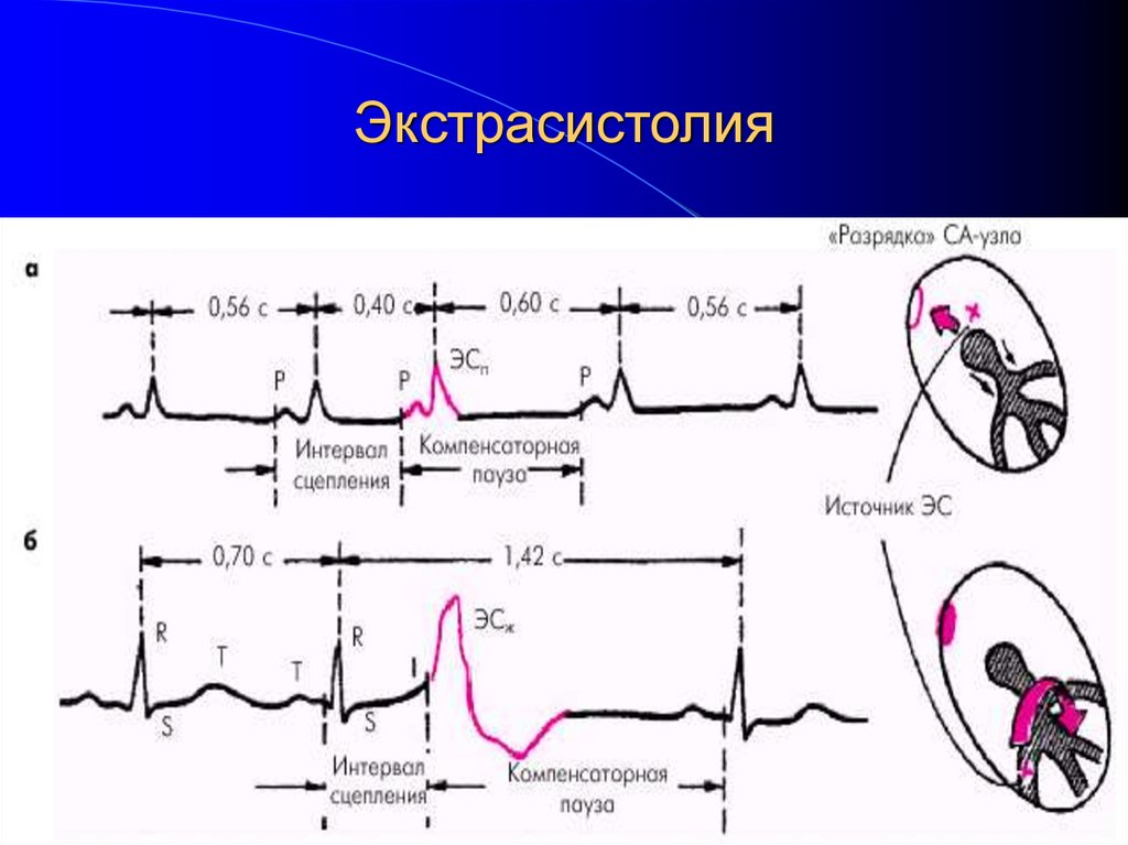 Экстрасистолия