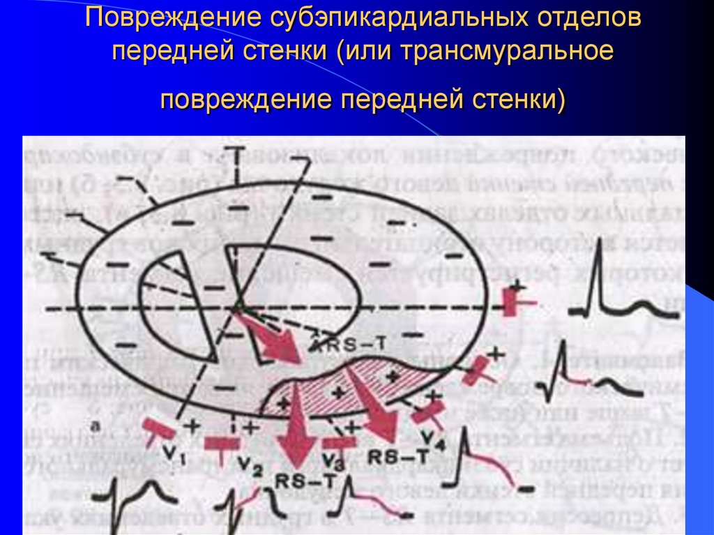 Повреждение субэпикардиальных отделов передней стенки (или трансмуральное повреждение передней стенки)