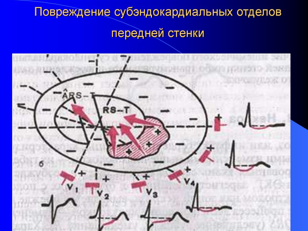 Повреждение субэндокардиальных отделов передней стенки