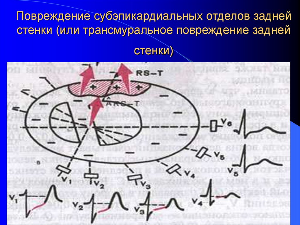 Повреждение субэпикардиальных отделов задней стенки (или трансмуральное повреждение задней стенки)
