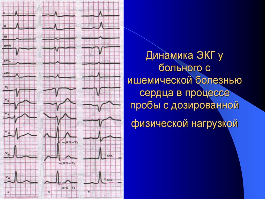 Динамика ЭКГ у больного с ишемической болезнью сердца в процессе пробы с дозированной физической нагрузкой
