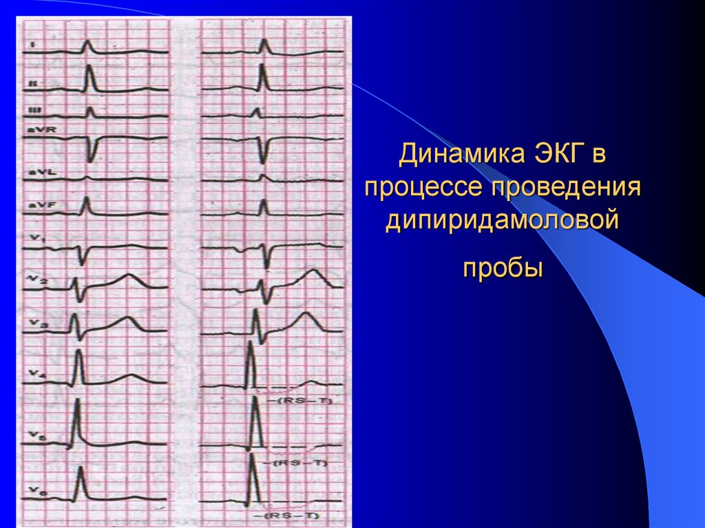 Динамика ЭКГ в процессе проведения дипиридамоловой пробы