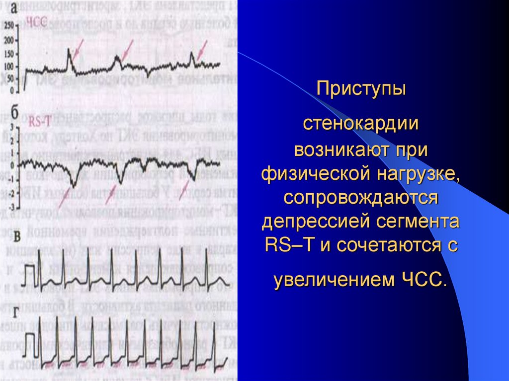 Приступы стенокардии возникают при физической нагрузке, сопровождаются депрессией сегмента RS–T и сочетаются с увеличением ЧСС.