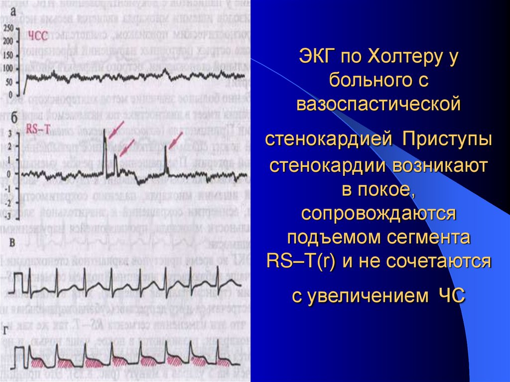ЭКГ по Холтеру у больного с вазоспастической стенокардией Приступы стенокардии возникают в покое, сопровождаются подъемом