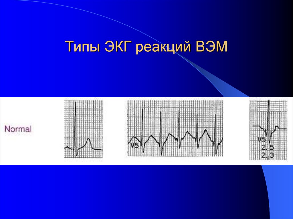 Типы ЭКГ реакций ВЭМ