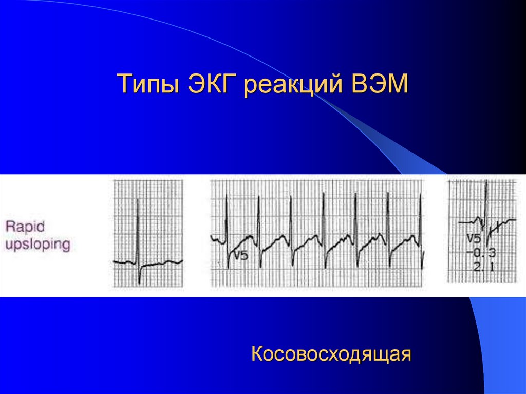 Типы ЭКГ реакций ВЭМ