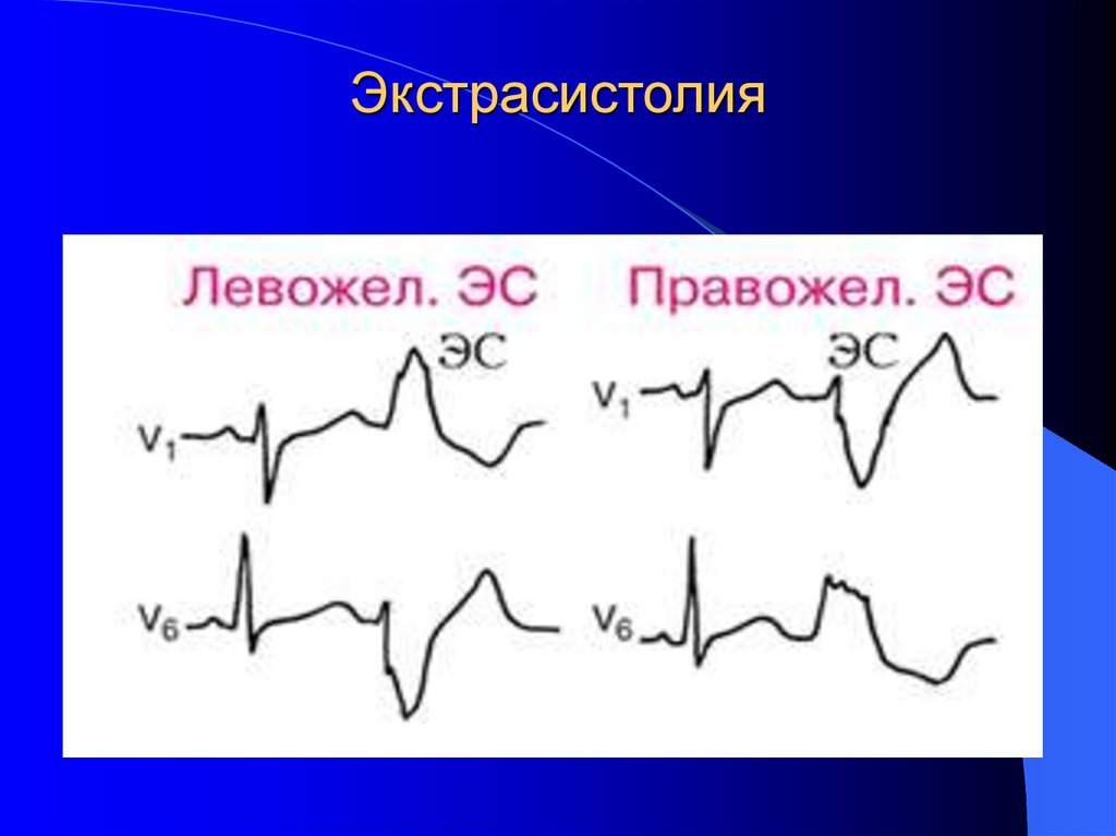 Экстрасистолия