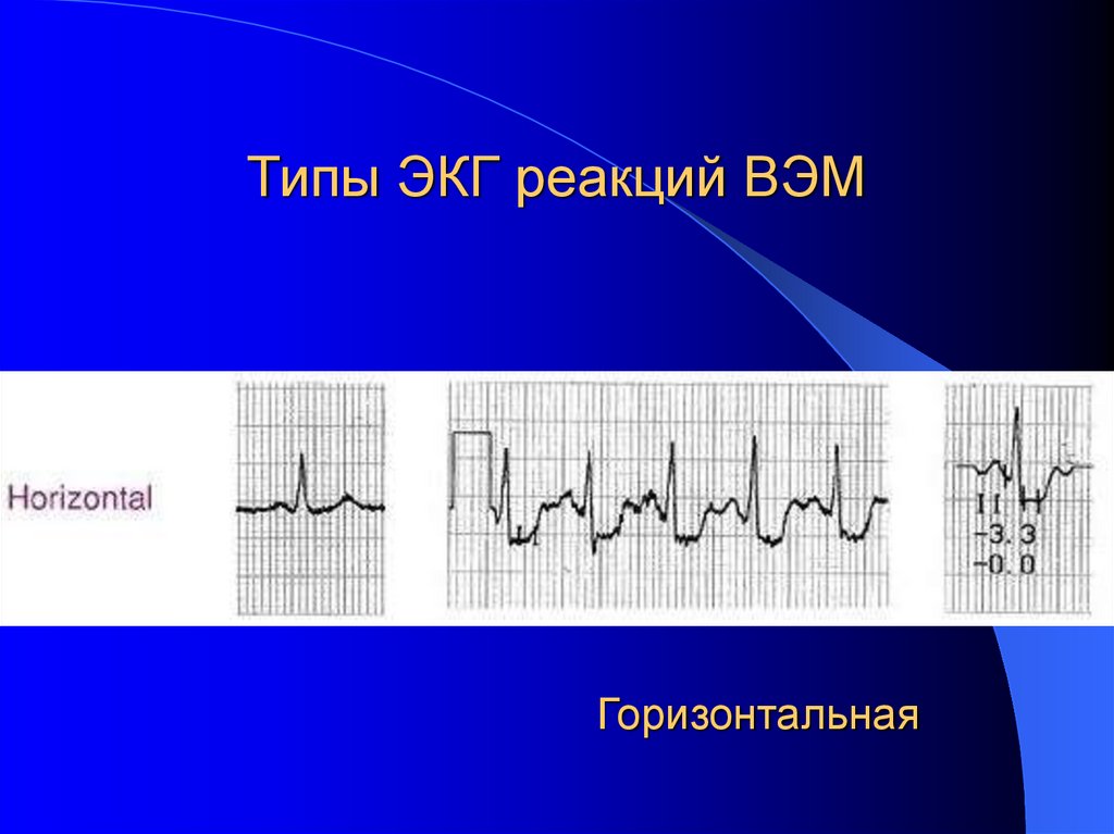 Типы ЭКГ реакций ВЭМ