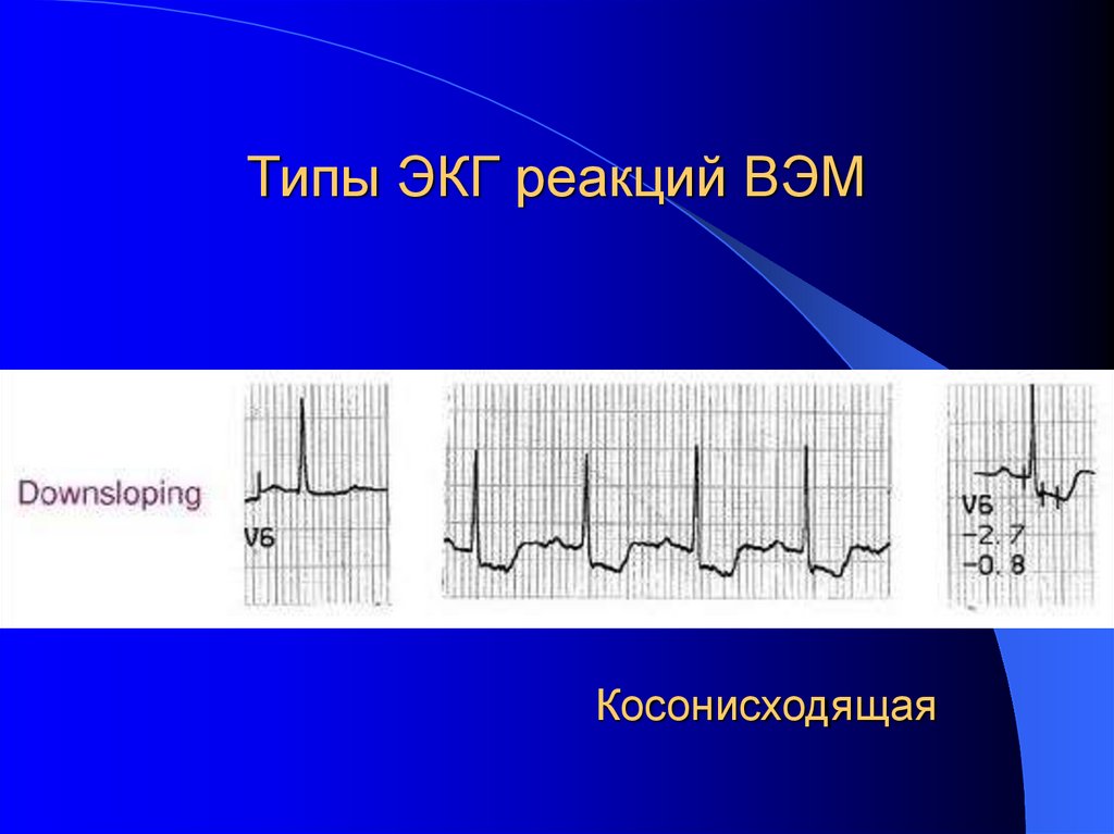 Типы ЭКГ реакций ВЭМ
