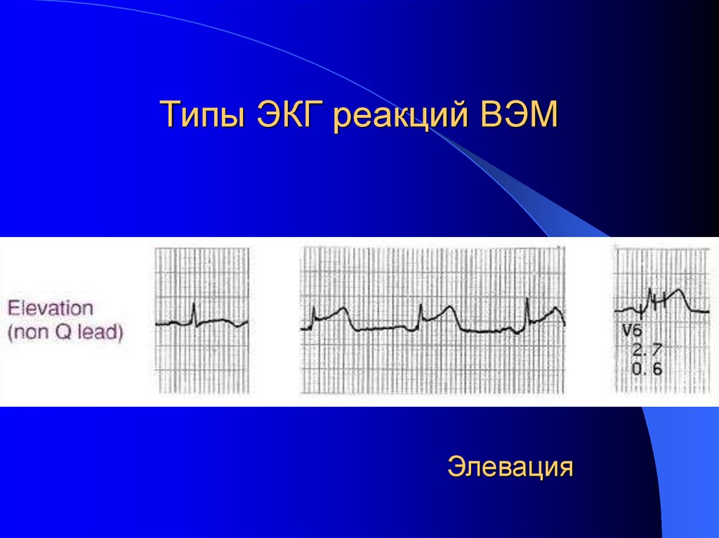 Типы ЭКГ реакций ВЭМ