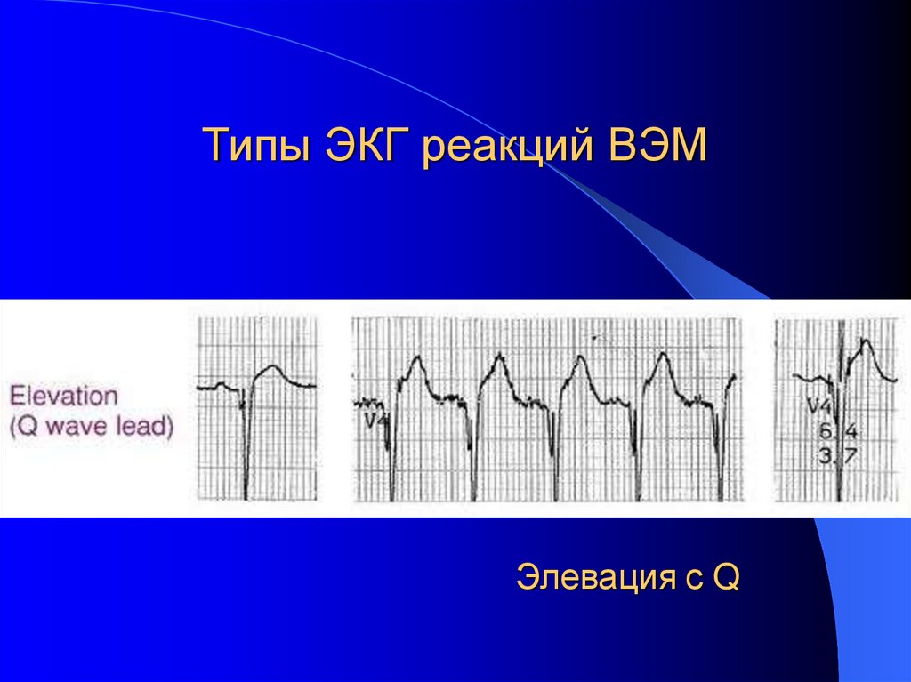 Типы ЭКГ реакций ВЭМ