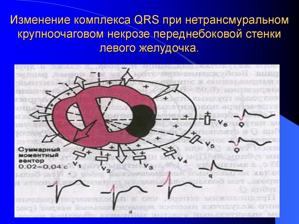 Изменение комплекса QRS при нетрансмуральном крупноочаговом некрозе переднебоковой стенки левого желудочка.