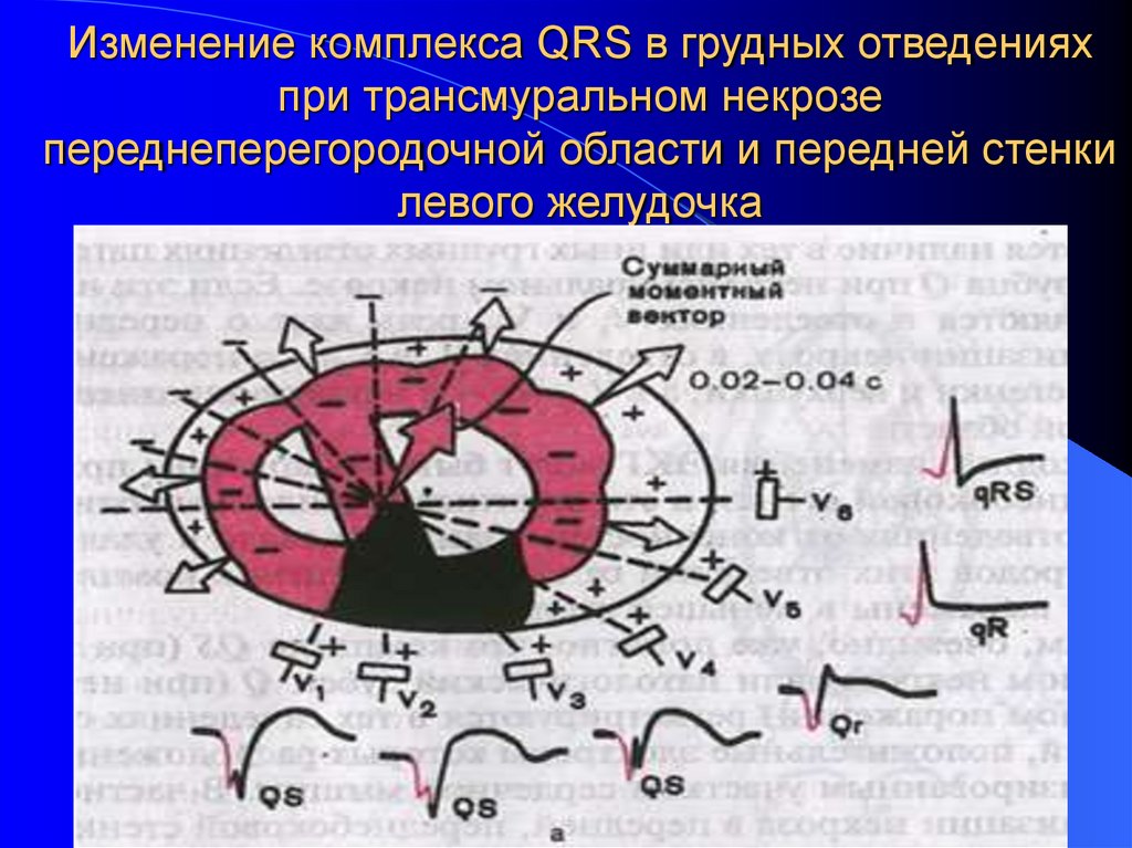 Изменение комплекса QRS в грудных отведениях при трансмуральном некрозе переднеперегородочной области и передней стенки левого
