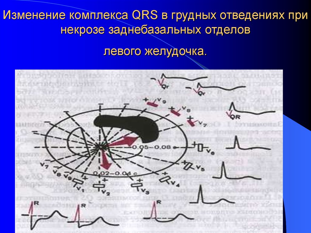 Изменение комплекса QRS в грудных отведениях при некрозе заднебазальных отделов левого желудочка.
