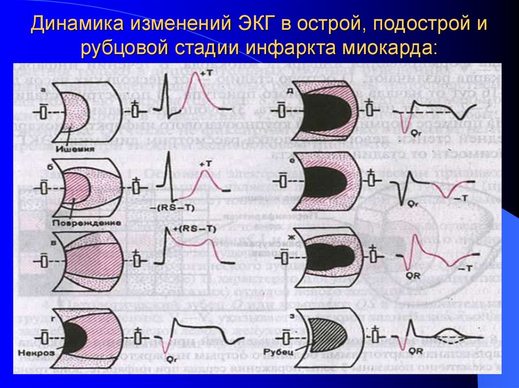 Динамика изменений ЭКГ в острой, подострой и рубцовой стадии инфаркта миокарда: