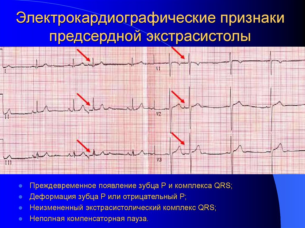 Электрокардиографические признаки предсердной экстрасистолы