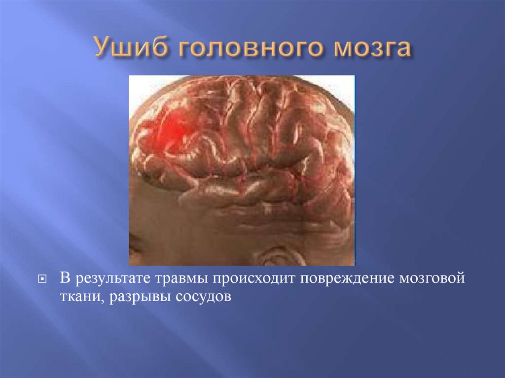 Ушиб головного мозга