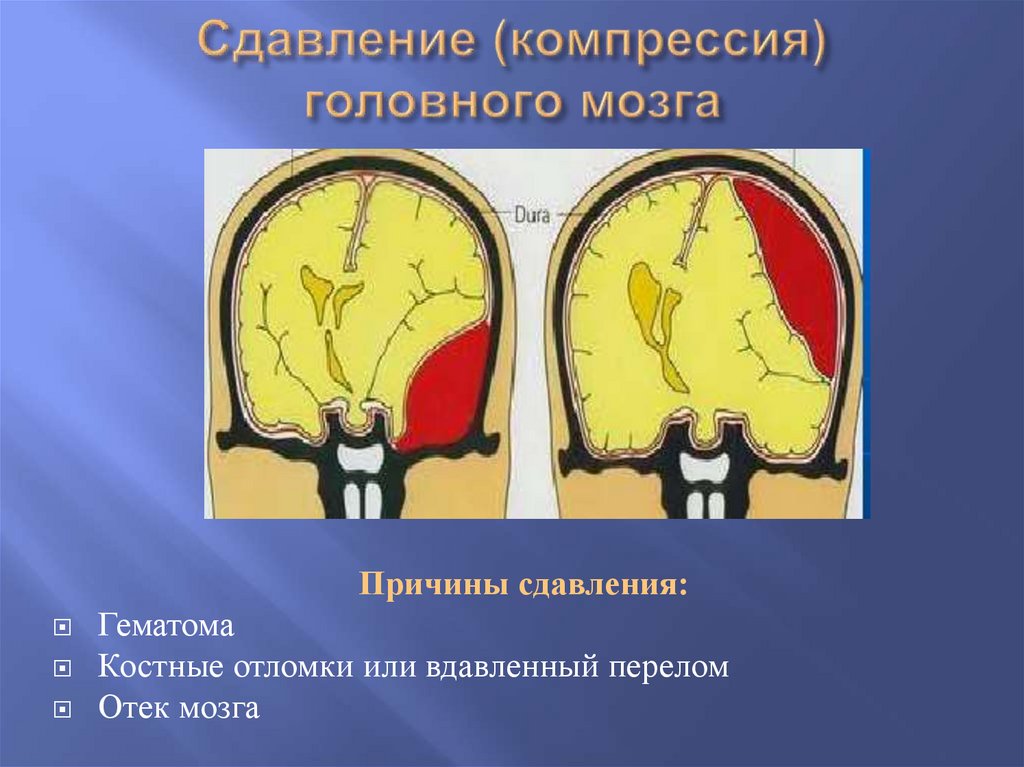 Сдавление (компрессия) головного мозга