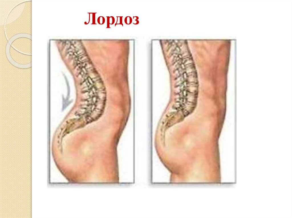 Лордоз