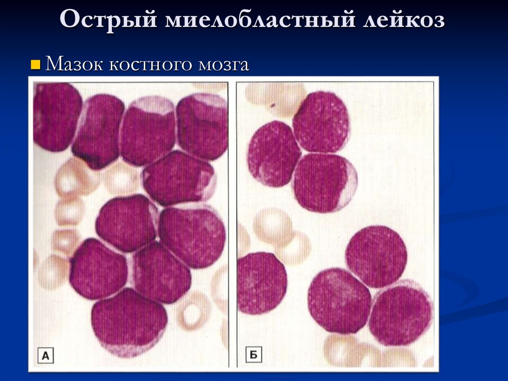 Острый миелобластный лейкоз