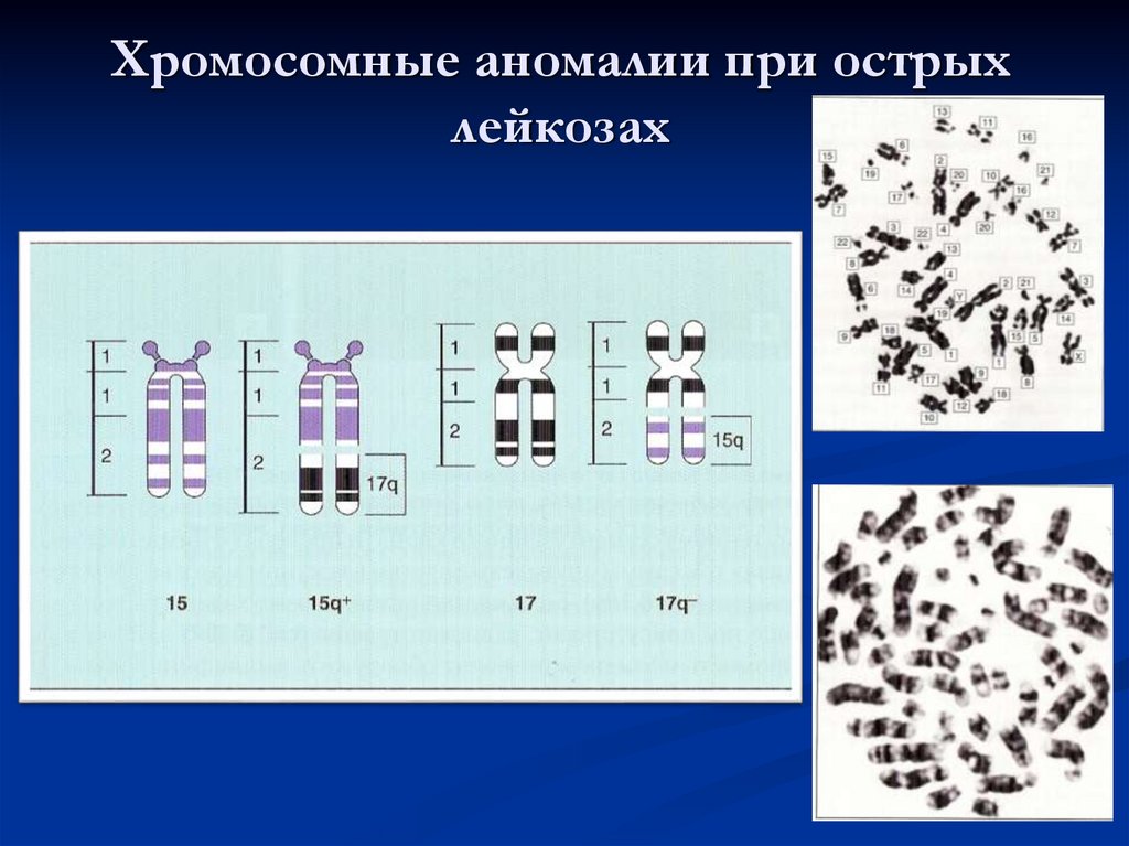 Хромосомные аномалии при острых лейкозах