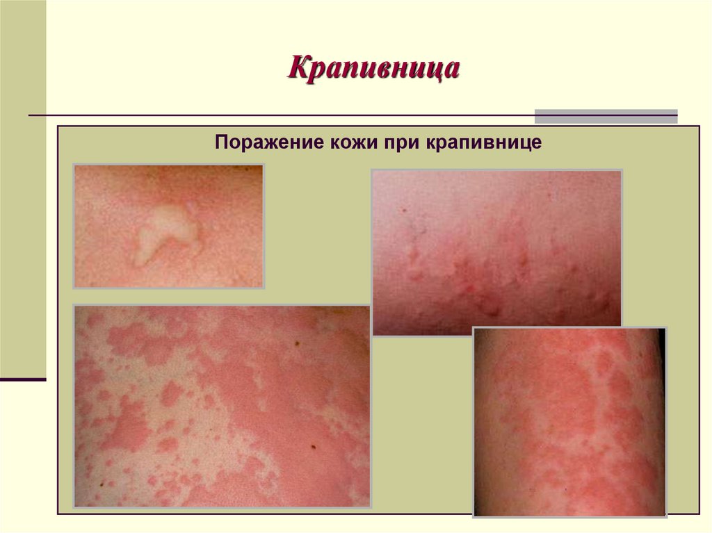 Крапивница