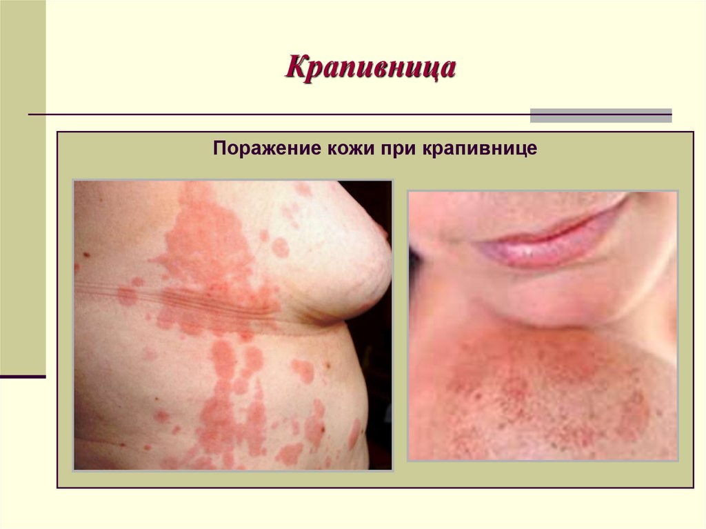 Крапивница