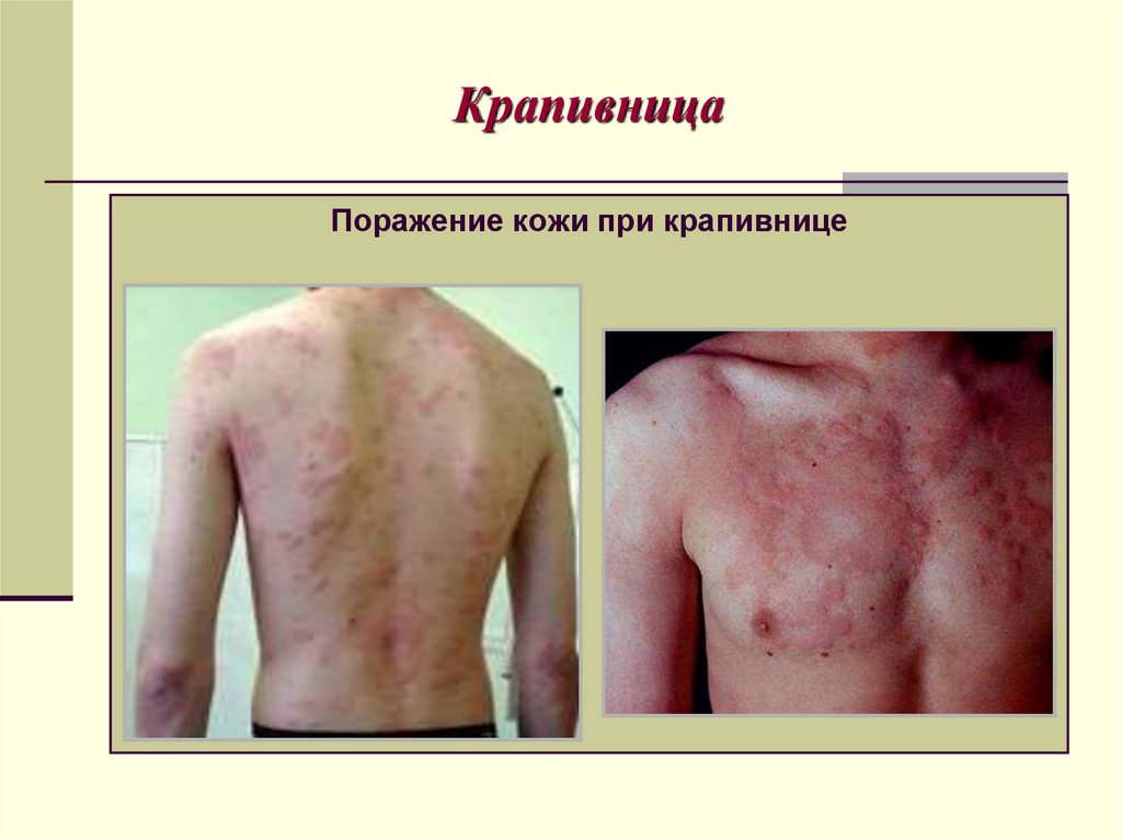 Крапивница